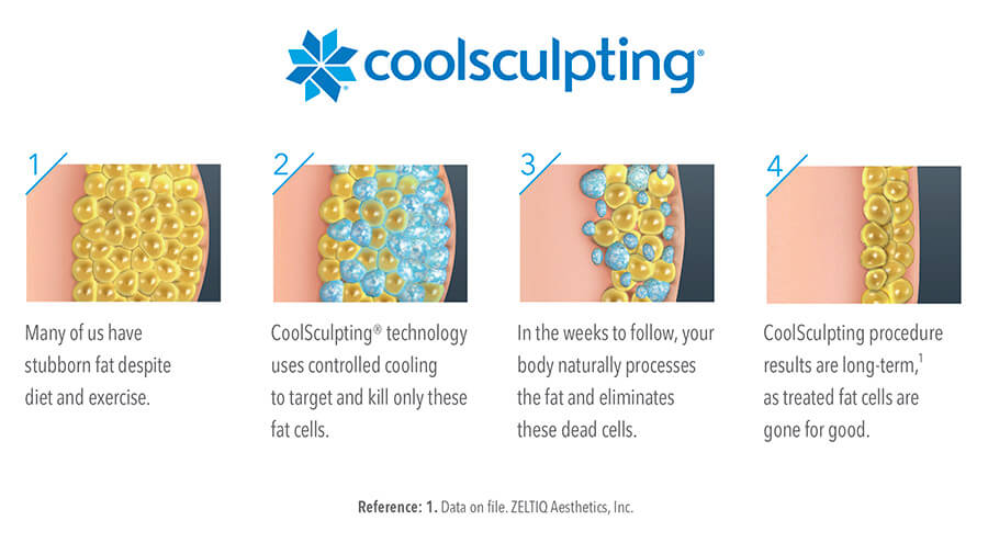 4 photos showing how CoolSculpting works