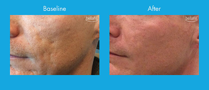Patient before and after acne scar treatment