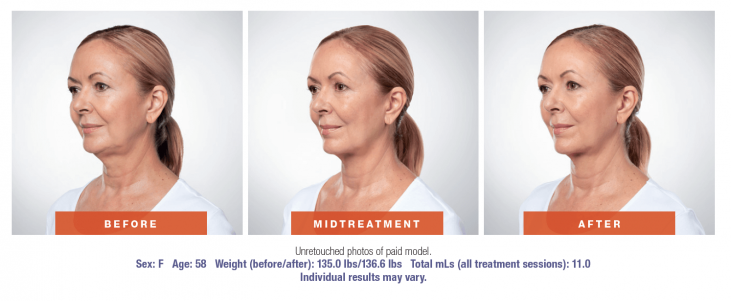 3 photos showing female patient before and after Kybella treatment