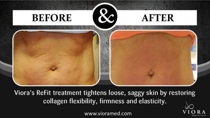 Photo of the female patient's abdomen before and after the Viora treatment