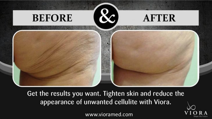 A photo of the female patient's buttocks before and after the Vior treatment