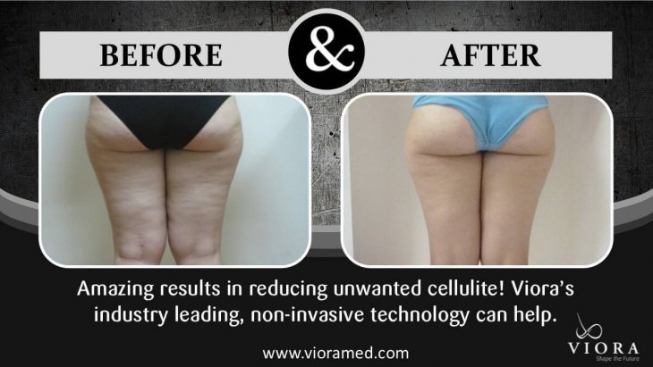 Photo of the female patient's buttocks and thighs before and after Viora treatment
