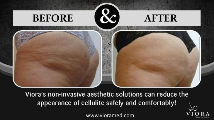 A photo of the female patient's buttocks before and after the Vior treatment