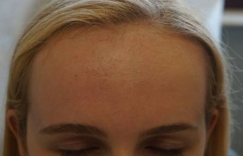 patient suffering from acne after Laser Genesis treatment