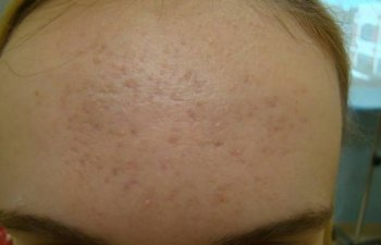 patient suffering from acne before Laser Genesis treatment