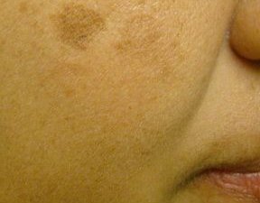female patient before mole removal