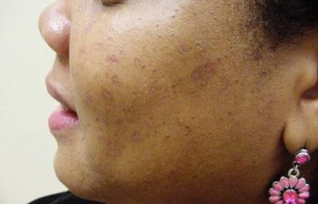 female patient after mole removal