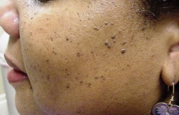 female patient before mole removal
