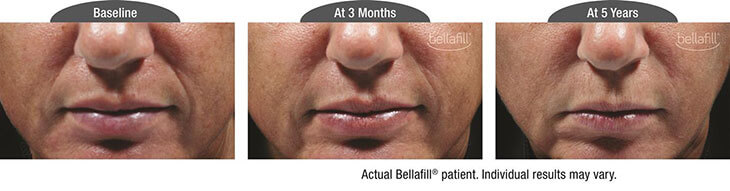 Three photos - Bellafill patient - baseline, at 3 months and at 5 years. Individual results may vary