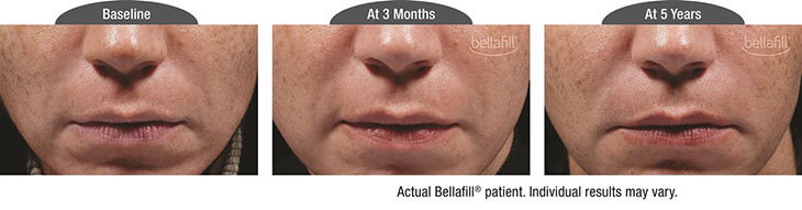 Three photos - Bellafill patient - baseline, at 3 months and at 5 years. Individual results may vary