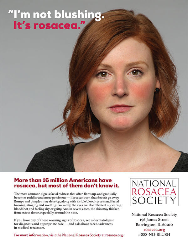 Advertising banner - More than 16 million Americans have rosacea, but most of them don't know it.