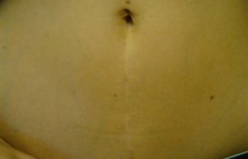 Patient After C-section Scar Removal