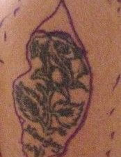 tattoo before surgical removal