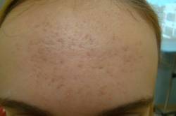 Close-up of a person's forehead with visible acne and redness.