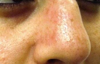 female patient after nose mole removal