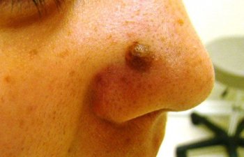 female patient before nose mole removal