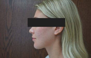 Cutera Secret RF treatment