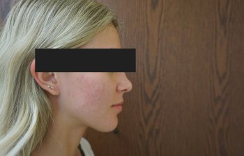 Cutera Secret RF treatment