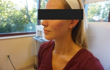 Cutera Secret RF treatment