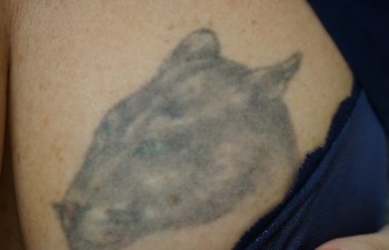 before tattoo removal
