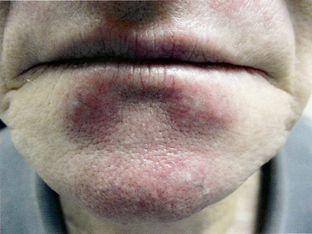 Close-up of a person's lower face showing a dark, discolored patch of skin on the chin and lower lip area.