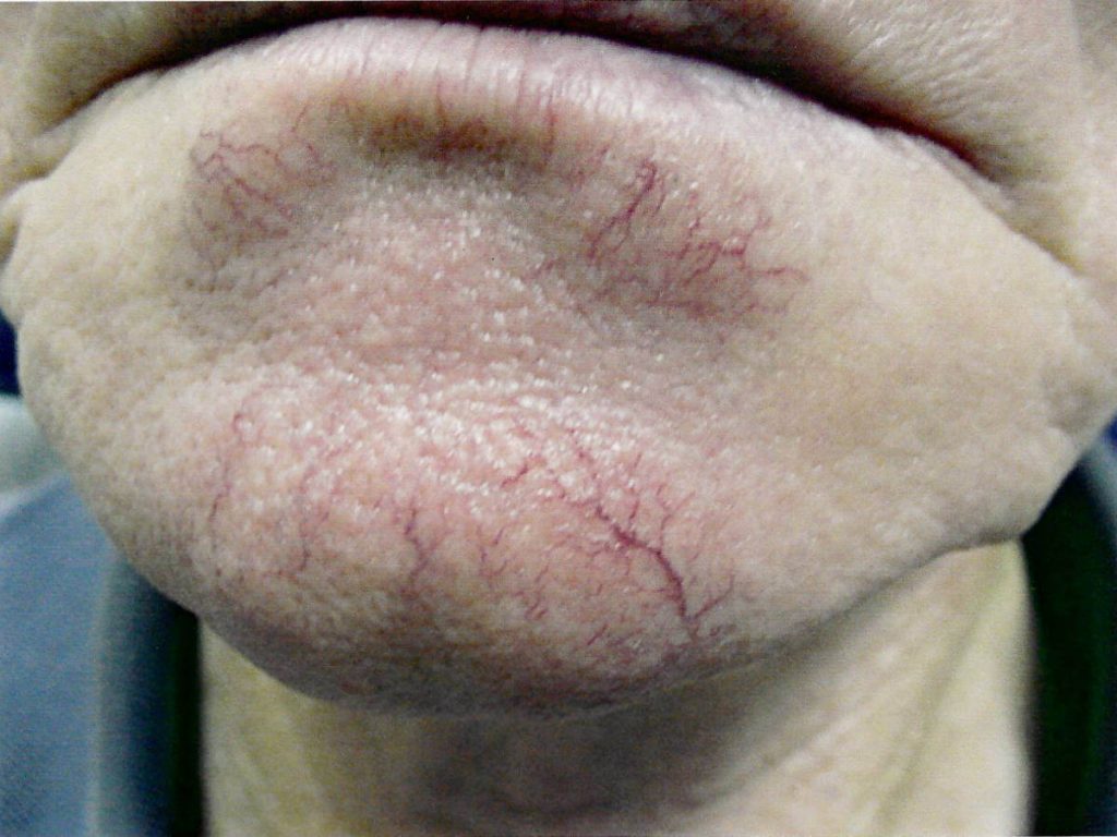 Close-up of a person's chin and lower lip showing visible dilated red blood vessels (telangiectasia) on the skin.