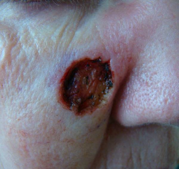 Close-up of a person's face showing a large, open, ulcerated lesion with red and dark tissue on the cheek near the nose.