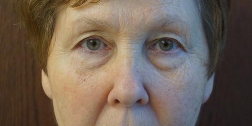 Close-up of an older woman’s face with visible wrinkles and sagging skin, looking directly at the camera against a plain background.