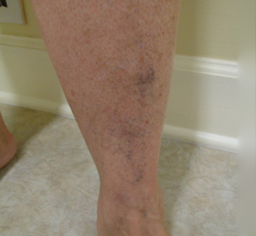 Vein Treatment Photo