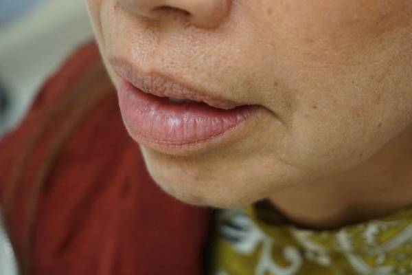 Close-up of a person's lower face, showing lips, chin, and part of the nose, with visible skin texture and wearing a maroon garment.