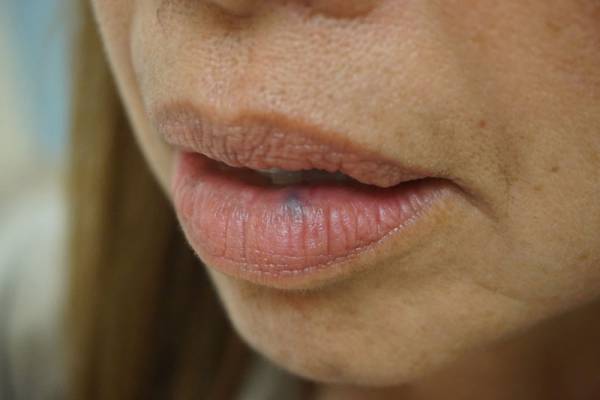 Close-up of a person's lips and lower face, showing natural skin texture and slight discoloration on the lower lip.