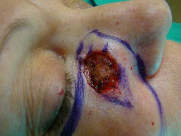 Close-up of a person's face showing a large, circular wound near the nose and lower eyelid, with surgical markings drawn around the affected area.