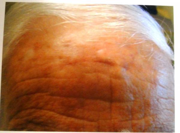 Close-up of an older person's forehead showing wrinkled skin with multiple small, slightly raised, and light brown spots.