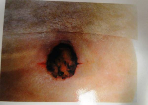 Close-up of skin with a dark, irregularly shaped lesion that appears raised and has uneven borders, surrounded by normal skin.