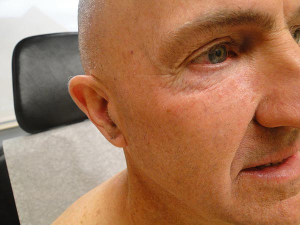 A close-up of the right side of a middle-aged man's face, showing his eye, ear, and surrounding skin in a clinical setting.