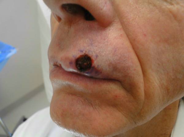 A close-up of a person's face showing a dark, raised lesion with irregular borders on the upper lip near the nose.