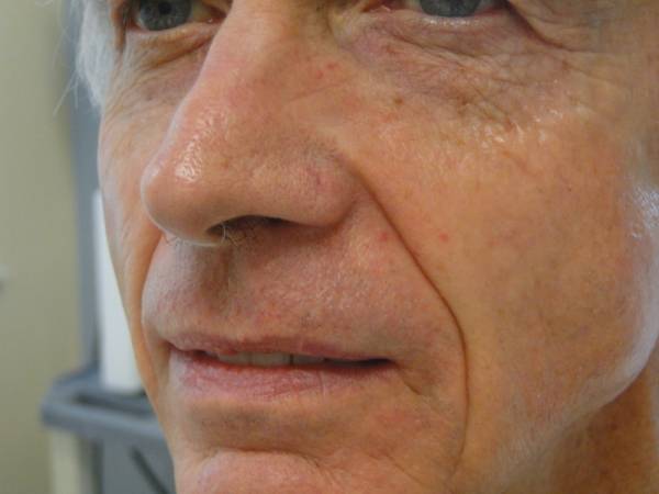 Close-up of the lower face of an older man with light skin, showing wrinkles, age spots, and visible skin texture.
