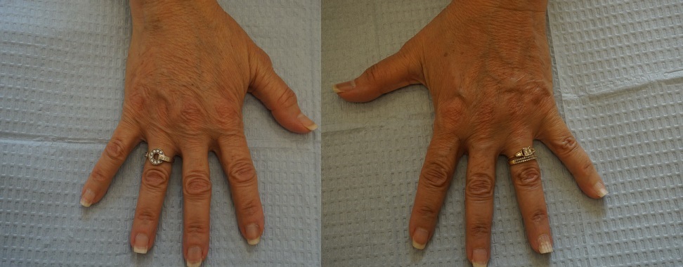 Two hands with visible signs of aging, such as wrinkles and prominent veins, shown resting on a textured white surface. Both hands wear rings on the ring finger.