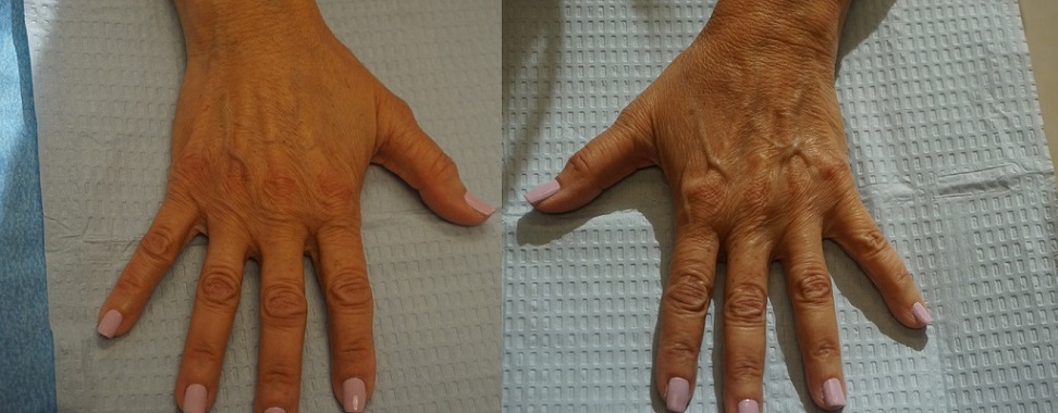 Two images show the back of a person's left hand resting on a textured medical cloth, with visible veins and light pink nail polish. The hand appears in slightly different positions.