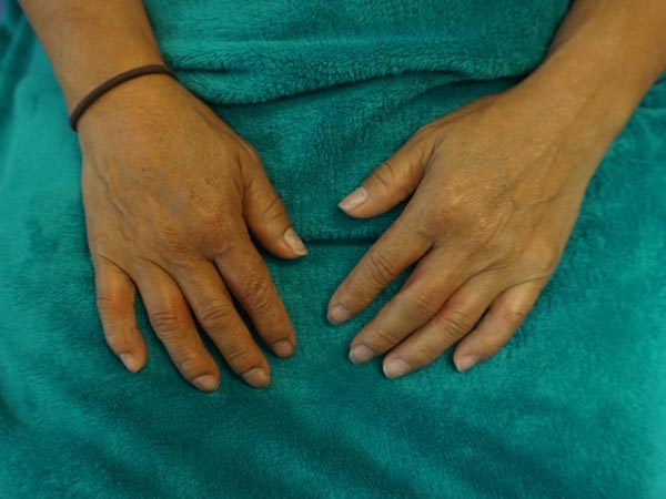 Two hands with visible joint swelling rest on a teal blanket; a brown hair tie is worn on the left wrist.