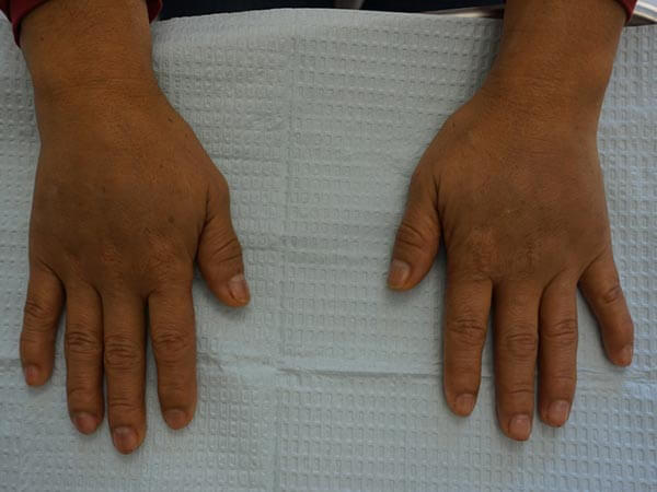 Two hands resting palms down on a white textured surface, showing visible swelling in fingers and wrists.