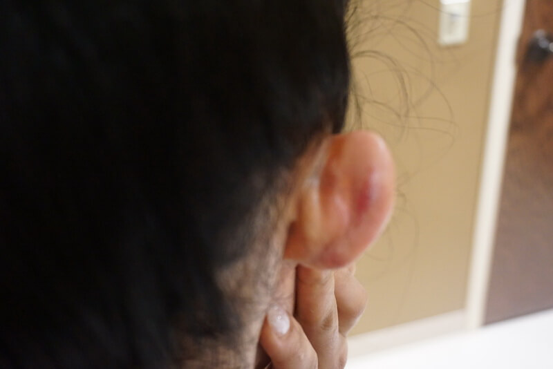 A person holding their hand near a swollen and reddish ear, with a blurred background showing part of a door and wall.