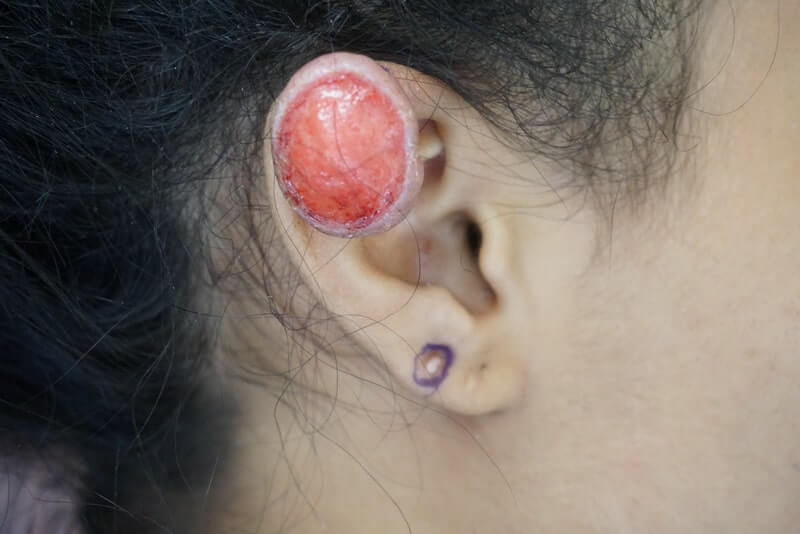 A close-up of a person's ear with a large, red, exposed wound on the upper ear and a smaller wound near the earlobe.