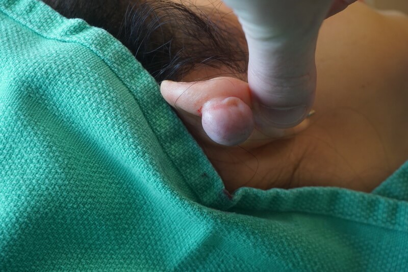 A close-up of a person's ear with a swollen, fluid-filled cyst on the earlobe, being examined by gloved hands in a medical setting.