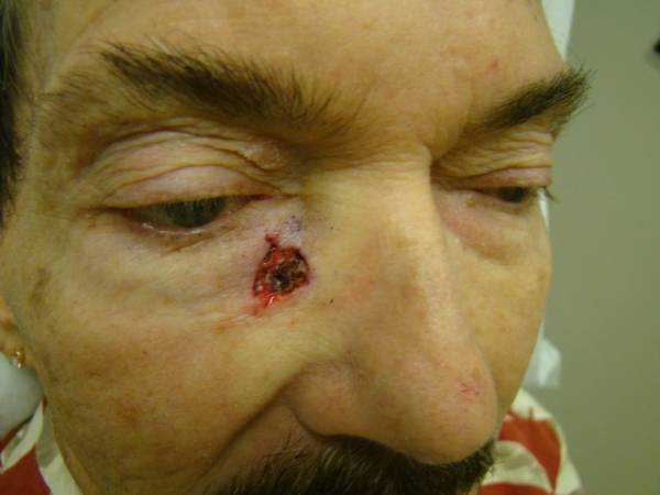Close-up of a man's face showing a wound with scabbing and redness near the inner corner of his left eye.