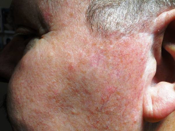 Close-up of a person's cheek showing redness, visible small blood vessels, and rough skin texture near the ear and sideburn area.