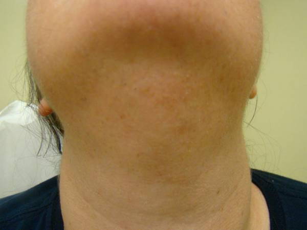 Close-up view of a person's neck and chin, showing skin texture and slight shadowing, with no visible jewelry or accessories.