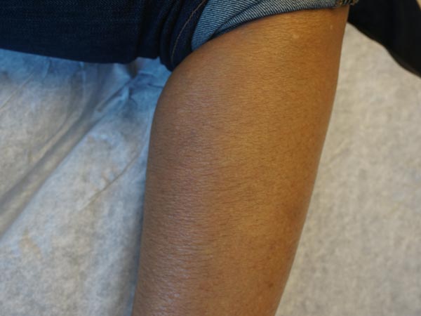 Vein Treatment Photo