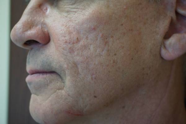 Close-up of an older man's face in profile, showing wrinkles, age spots, and some redness on the cheek and jawline.