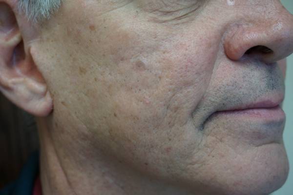 Close-up of the lower half of an older man's face, showing skin texture, age spots, and slight facial hair.